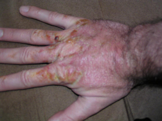 poison oak hand