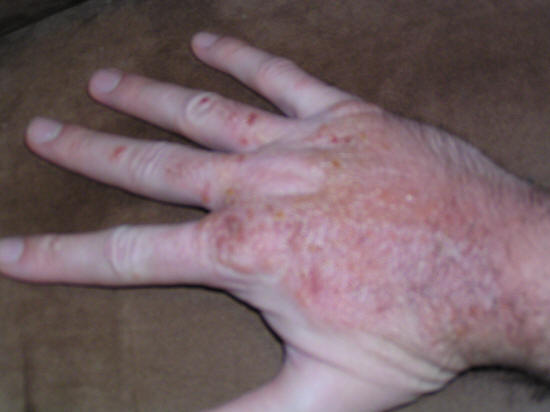 itchy poison oak