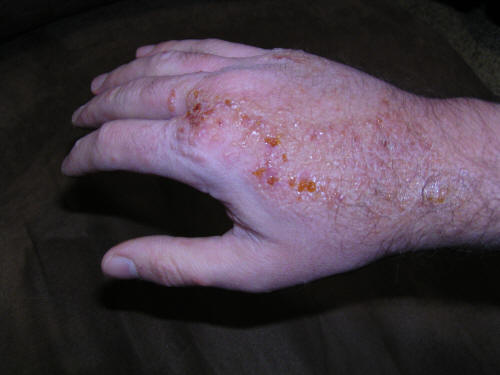 poison oak on hand