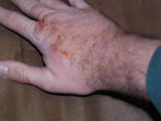 poison oak blisters